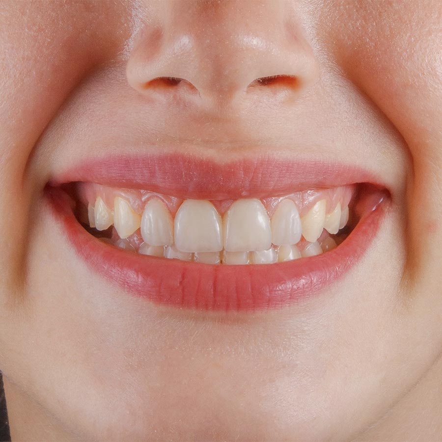 Treatment with LED Lollipop Sleeve